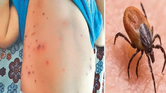 स्वाइन फ्लू के बाद अब उत्तराखंड में स्क्रब टाइफस ने बढ़ाई चिंता, 165 की जांच में 36 संक्रमित

