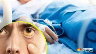 चंदौली में पीलिया ने ली युवक की जान, जानें लक्षण और बचाव के उपाय।