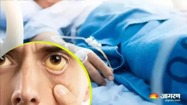 चंदौली में पीलिया बीमारी ने ले ली युवक की जान, द‍िखे लक्षण तो हो जाएं सावधान
