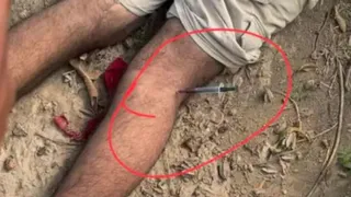 मृतक की टांग में लगी सिरिंज।