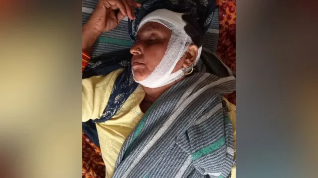 संभल में बंदरों झुंड ने किया महिला पर हमला, सिर में आए 47 टांके
