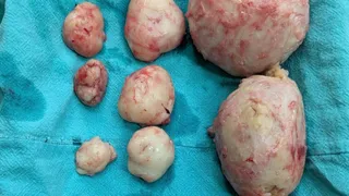 प्रयागराज में युवती के गर्भाशय से डॉक्टरों द्वारा ऑपरेशन करके निकाली गई गांठें। सौ. अस्पताल