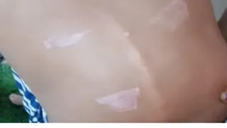 गर्म चीज से दागने के चलते बच्ची की पीठ पर पड़े निशान। (वीडियो ग्रैब)