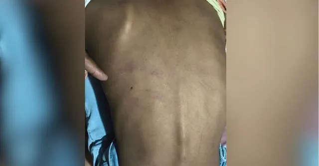 पड़ोसियों की बर्बरता, चोरी के आरोप लगा बच्ची को बंधक बनाकर पीटा, पीठ पर पड़े निशान
