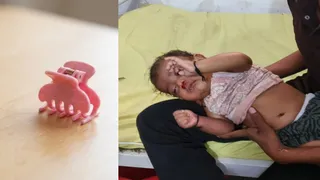 सोनभद्र में तीन माह के मासूम ने निगला क्लेचर, गले में फंसने से परिजनों की अटकी सांसें।