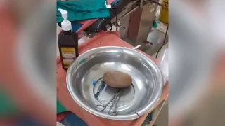 मलद्वार से निकाला गया डेढ़ किलोग्राम का पत्थर।