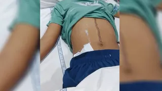 बेंच पर बैठने को लेकर दो बच्चों में हुई लड़ाई, पेट में लगे 22 टांके लगे।