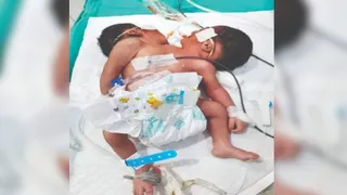 ओडिशा में दो सिर वाला बच्चा। फोटो जागरण