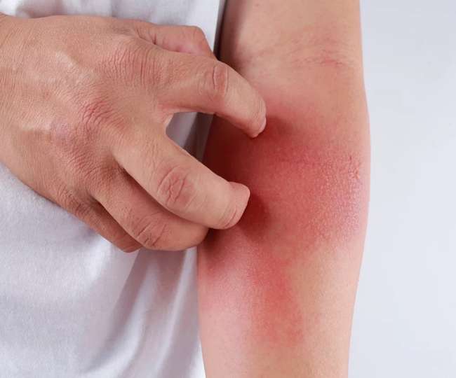 लगातार हो रही है खुजली तो हो जाइए सावधान, किडनी पर पड़ सकता है असर -  Itching can be a big symptom Be Careful About Your Kidney