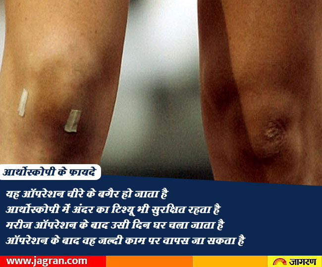 जानिए क्या है लिगामेंट इंजरी, घुटने टूटने के बाद भी संभव हुआ इलाज, फिर दौड़ सकेंगे Knee Injury