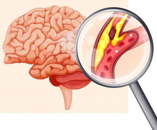भारत में हर साल 1.5 लाख लोग ब्रेन स्ट्रोक के शिकार, एक्सपर्ट से जानें क्या है इसकी वजह, लक्षण एवं बचाव - What is brain stroke know about its causes symptoms and prevention
