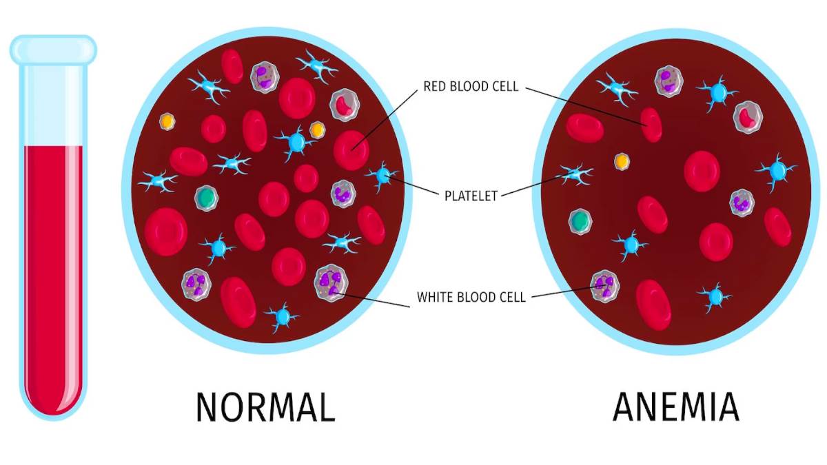 https://www.jagranimages.com/images/newimg/01022023/01_02_2023-anemia_symptoms_f_23315883.jpg