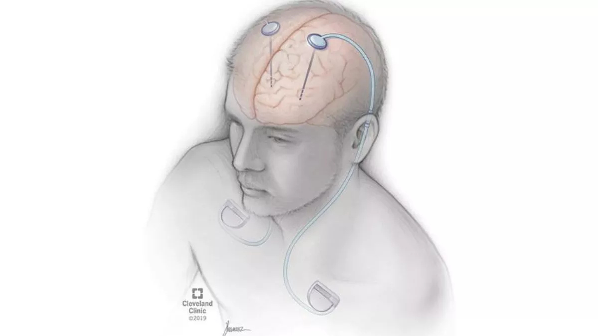 दिल्ली में अनोखी सर्जरी: पार्किंसन बीमारी को कंट्रोल करने को मरीज के दिमाग में डाला गया पेसमेकर जैसा उपकरण