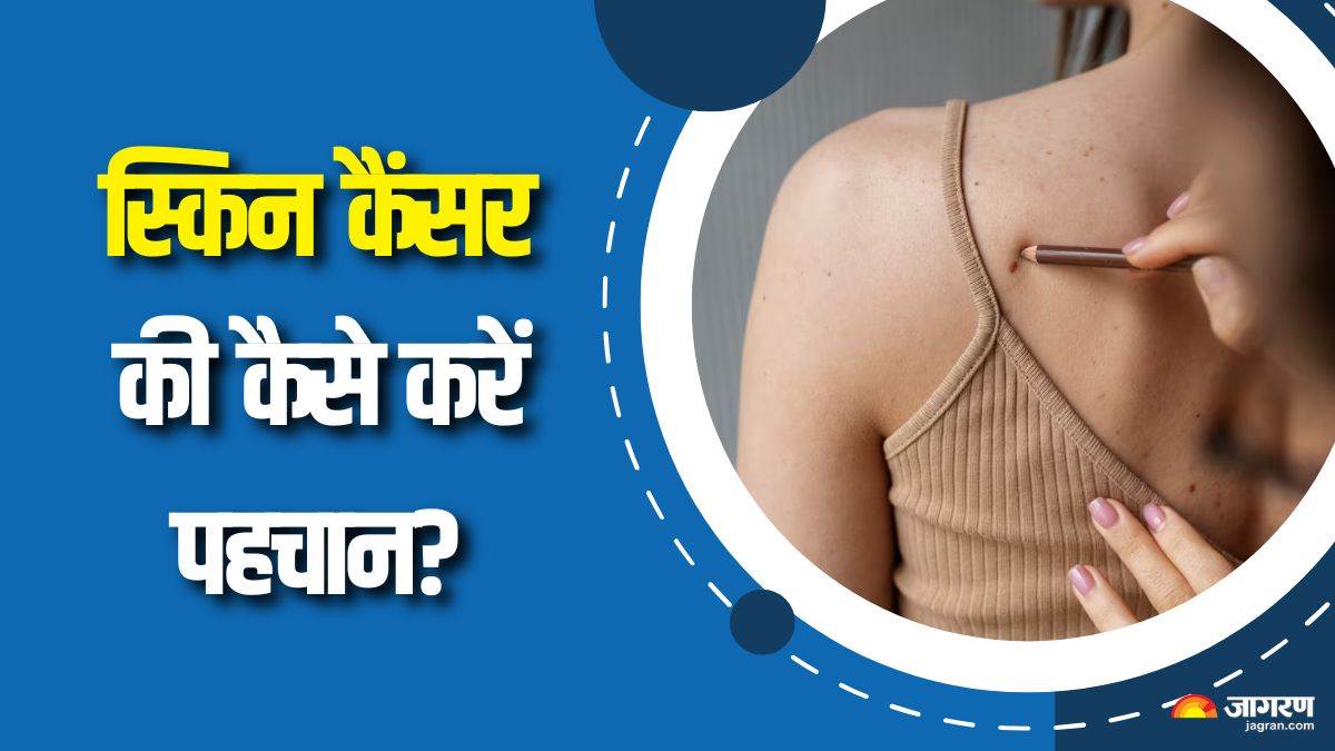 https://www.jagranimages.com/images/newimg/01092025/01_09_2025-skin_cancer_early_symptoms_24032002.jpg