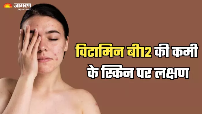 विटामिन बी12 की कमी होने के संकेत (Picture Credit- Freepik)