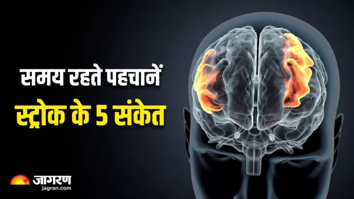 स्ट्रोक के ये 5 संकेत न करें अनदेखा (Image Source: Freepik)
