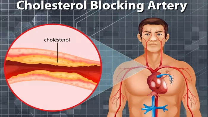 Blocked Arteries: आर्टरी ब्लॉकेज के कारण लक्षण और उपचार