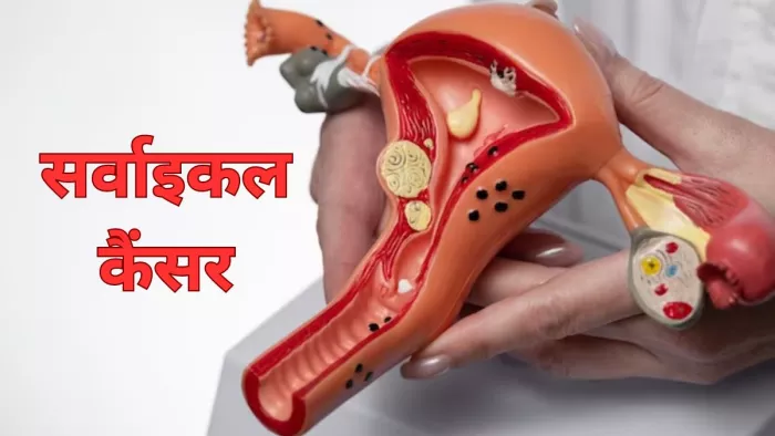 जानें सर्वाइकल कैंसर से जुड़ी सभी अहम बातें