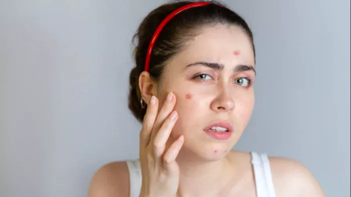 Pimple Home Remedies: पिंपल्स दूर करने के कारगर घरेलू उपाय