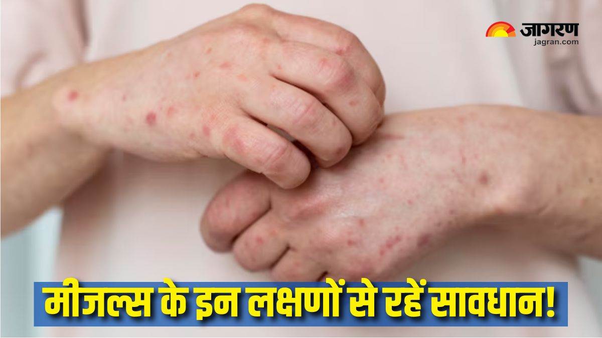 https://www.jagranimages.com/images/newimg/02042025/02_04_2025-measles_outbreak_in_usa_23910301.jpg