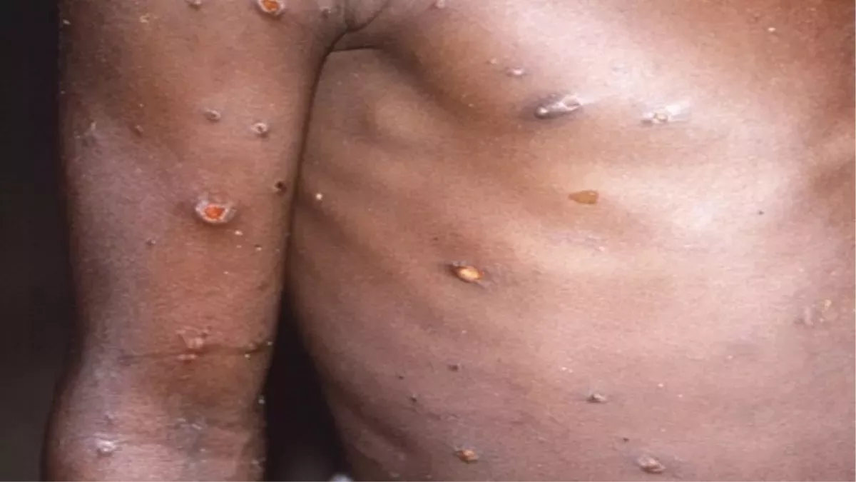Monkeypox Case : मंकीपाक्स का बढ़ा खतरा, सभी जिले अलर्ट पर, स्‍वास्‍थ्‍य विभाग ने जारी क‍िए निर्देश