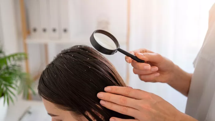 Dandruff Home Remedies: सरसों तेल से दूर करें डैंड्रफ की समस्या