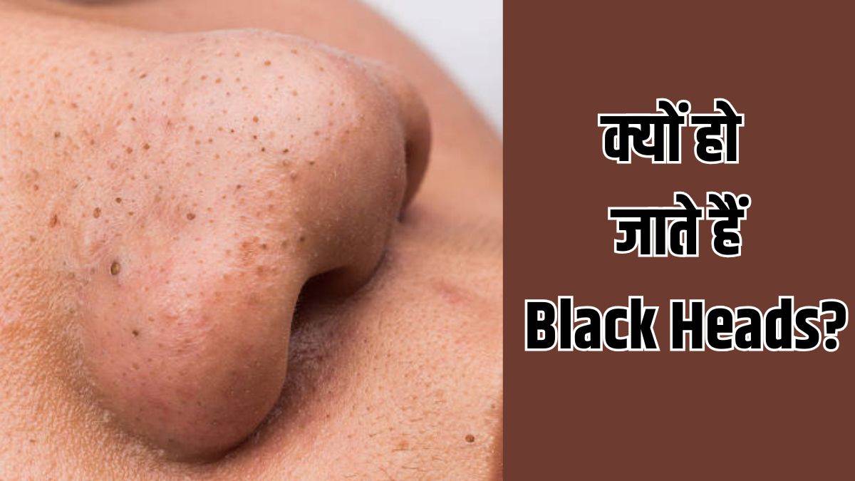 https://www.jagranimages.com/images/newimg/02092025/02_09_2025-black_heads_removal_tips_24031784.jpg