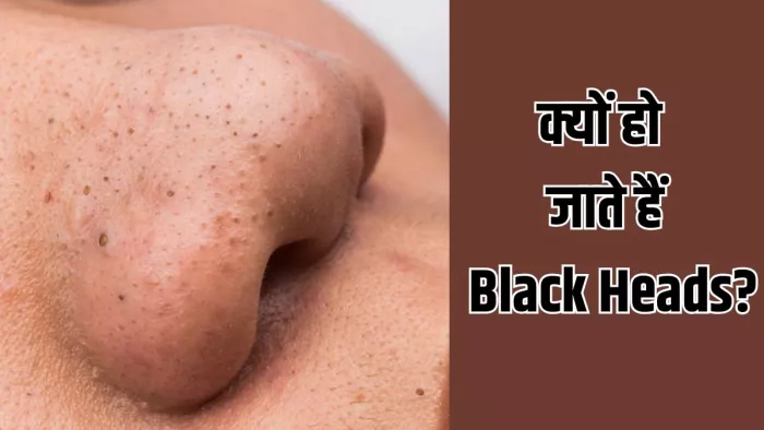 Black Heads से कैसे पाएं छुटकारा (Image Credit- Freepik)
