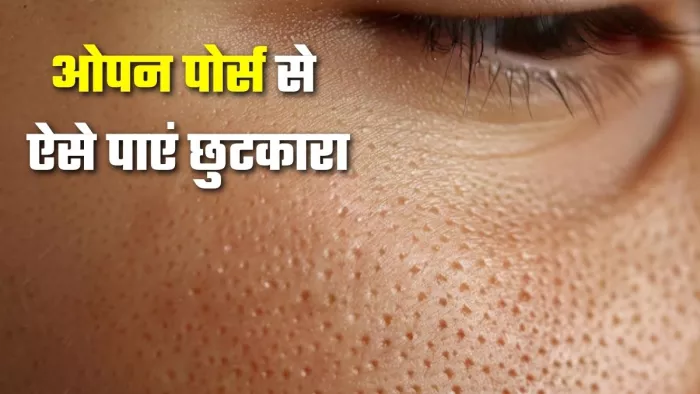 ओपन पोर्स की परेशानी को कम करेंगे 5 टिप्स (Image Source: Freepik)