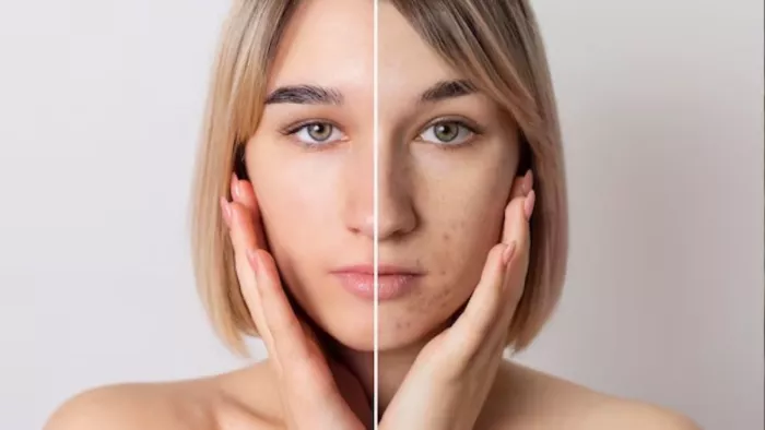 Remedies For Dark Spot: चेहरे के दाग-धब्बों को दूर करने के लिए अपनाएं ये उपाय