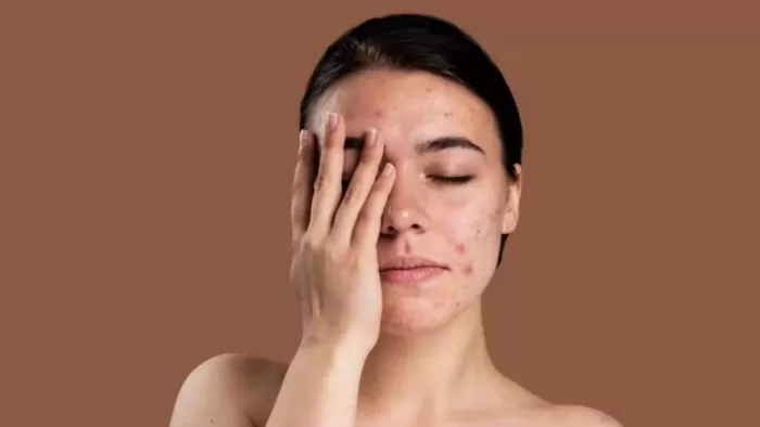 Skin Care Tips: पिगमेंटेशन से राहत पाने के लिए अपनाएं ये घरेलू उपाय
