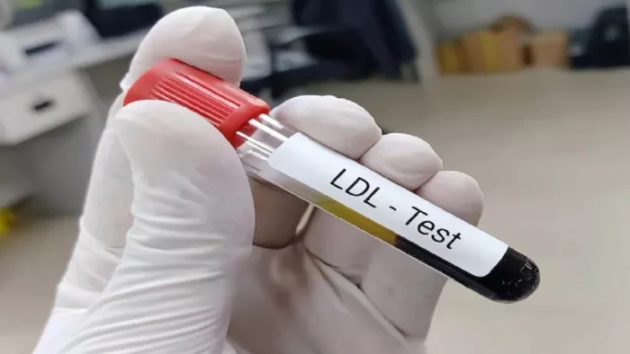 High Cholesterol : इन 5 चीजों के सेवन से बढ़ते कोलेस्ट्रॉल को आसानी से कर सकते हैं कंट्रोल