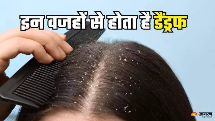 डैंड्रफ की वजह होती हैं इन विटामिन्स की कमी (Picture Credit- Freepik)