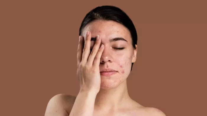Pigmentation: त्वचा की झाइयों को दूर करने के लिए अपनाएं ये उपाय