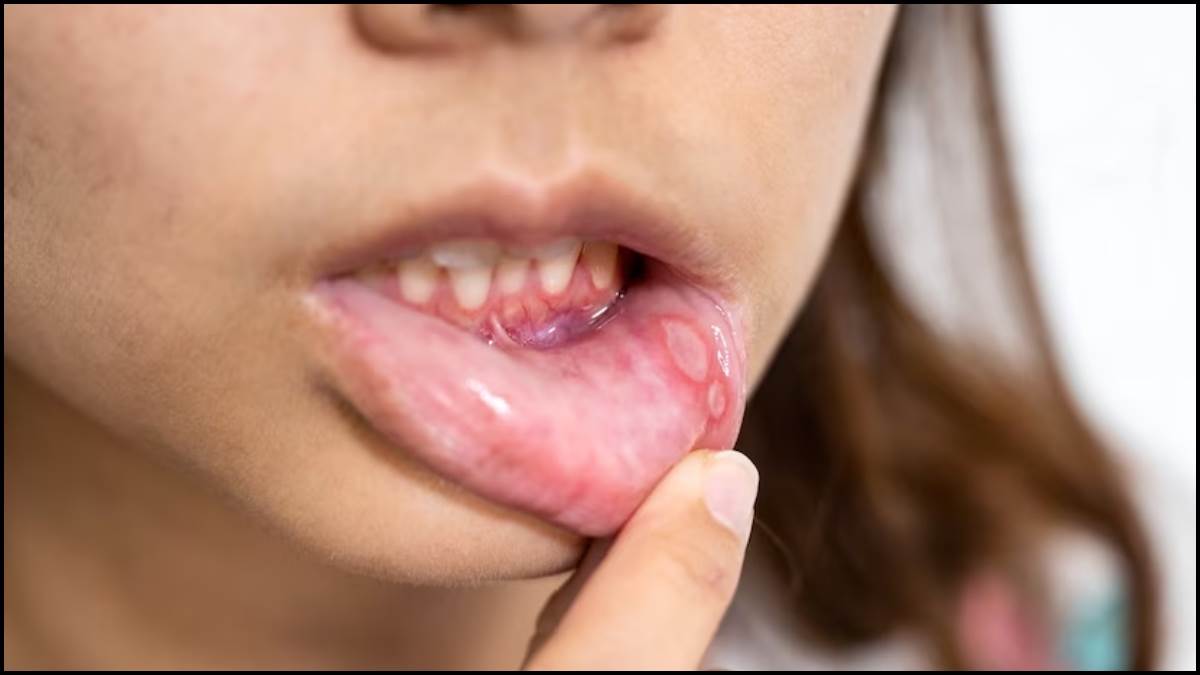 https://www.jagranimages.com/images/newimg/03052023/03_05_2023-mouth-ulcers_23401755.jpg