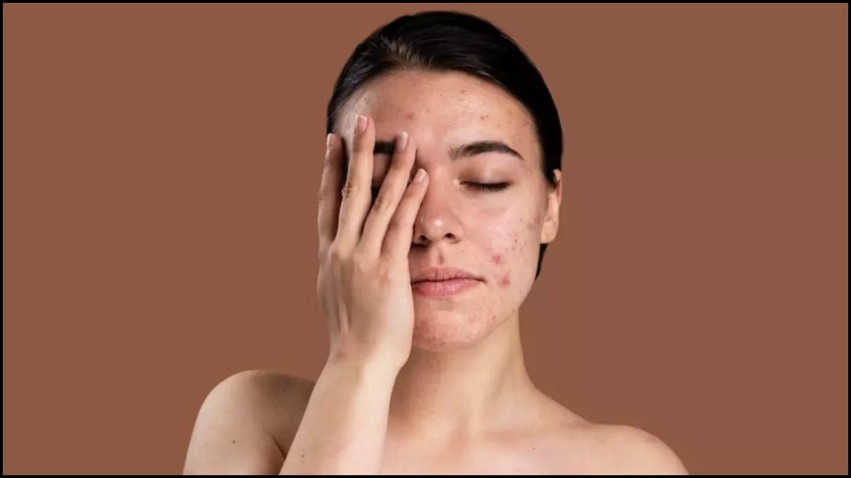 Pimple Face Pack मुहांसों की वजह चेहरे पर हो गए हैं दाग और गड्ढे, तो