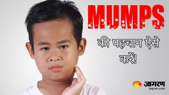 राजधानी में पैर पसार रहा मम्प्स इन्फेक्शन
