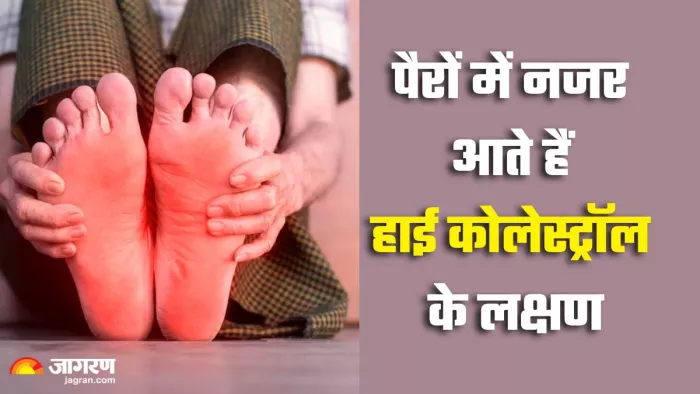 कोलेस्ट्रॉल बढ़ने के संकेत (Picture Credit- Freepik)