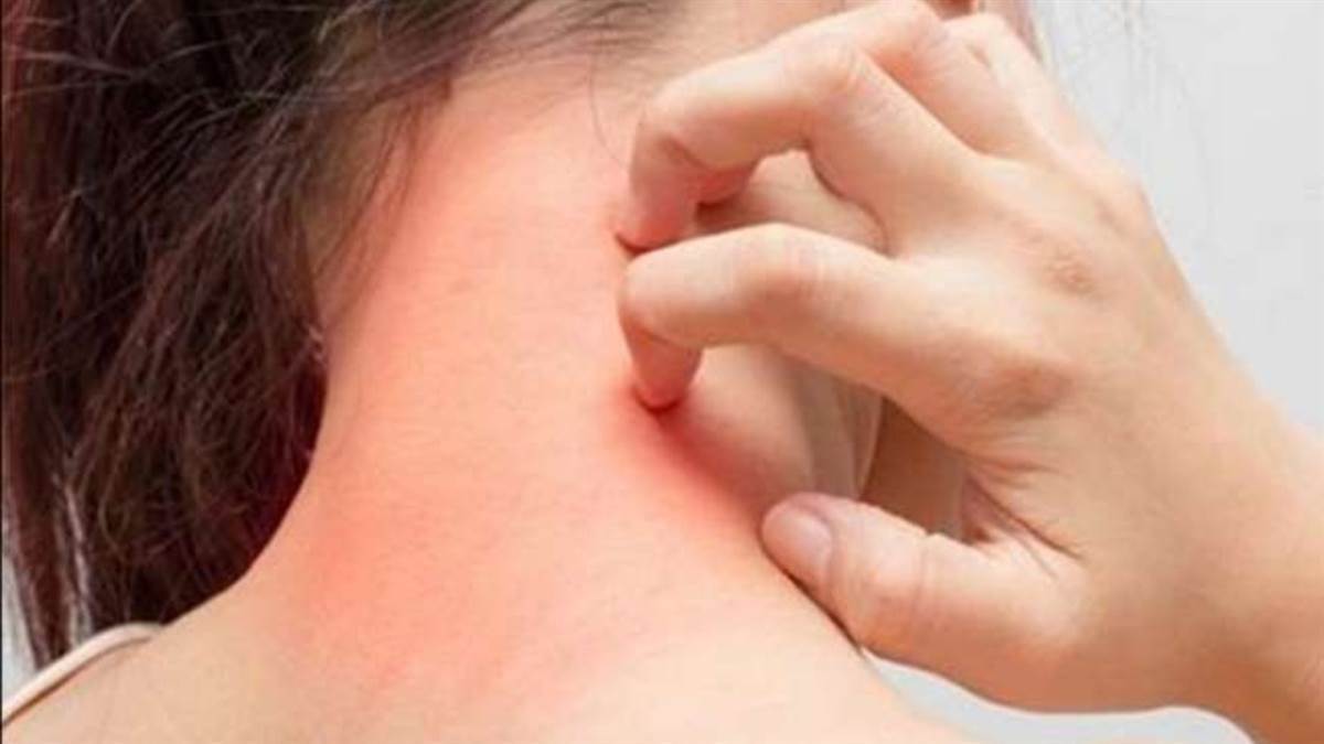 https://www.jagranimages.com/images/newimg/03072025/03_07_2025-skin_infection_23973861.jpg