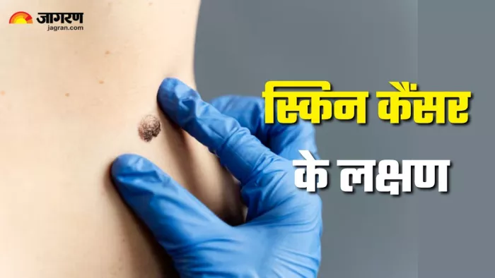 ऐसे पहचानें स्किन कैंसर के शुरुआती लक्षण (Picture Credit- Freepik)