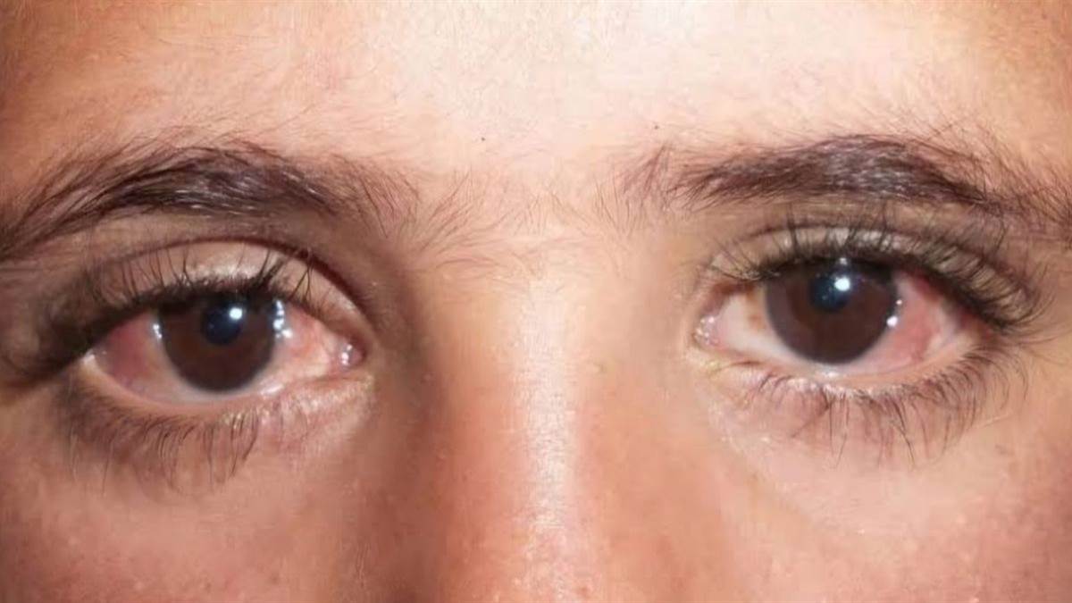 https://www.jagranimages.com/images/newimg/03092025/03_09_2025-eye_24034170.jpg