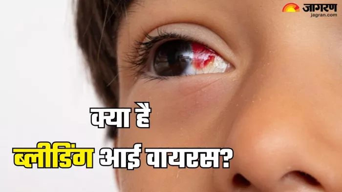 रवांडा में ब्लीडिंग आई वायरस का कहर (Picture Credit- Freepik)