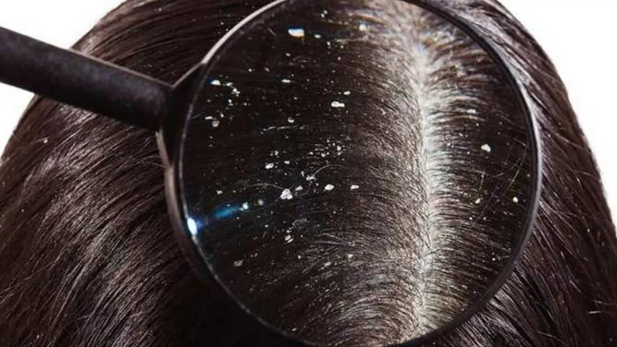 How To Remove Dandruff: बालों में जमी डैंड्रफ से क्यों होना शर्मिंदा? इन सर्दियां रुसी को कहे 'टाटा, बाय-बाय'