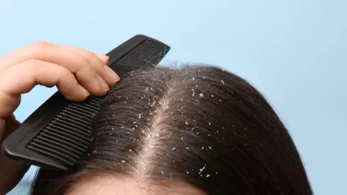 बालों में डैंड्रफ ( Dandruff remedies at home) होना एक आम बात है। (Pic courtesy : Freepik)