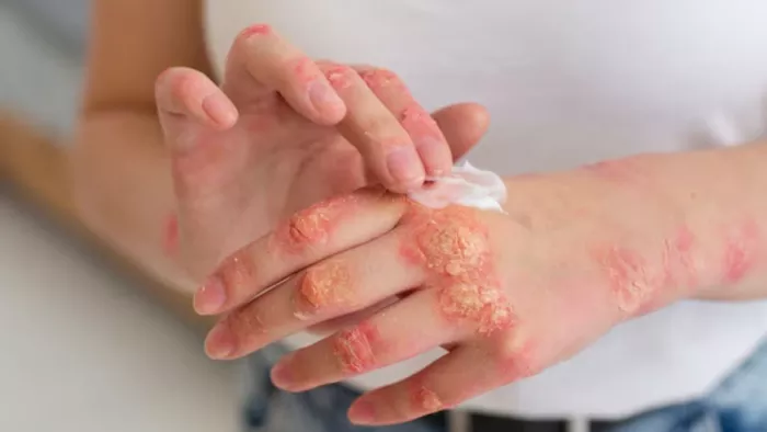Herpes Virus से स्किन से जुड़ी समस्याएं होती है। ( Pic Courtesy : Freepik)