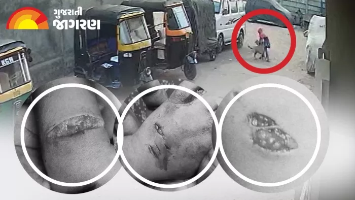 सूरत के वेडरोड इलाके में कुत्ते ने किया बच्ची पर हमला