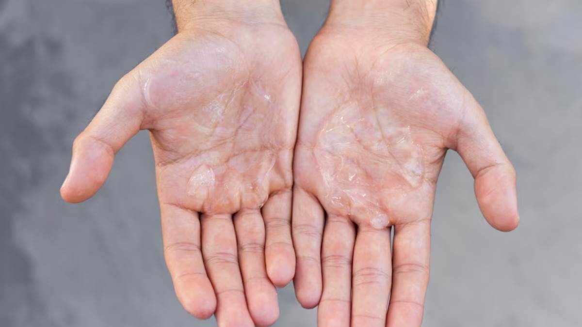 Dry Hands बदलते मौसम में शुष्क हो रहे हैं आपके हाथ? जानें इसकी वजह और