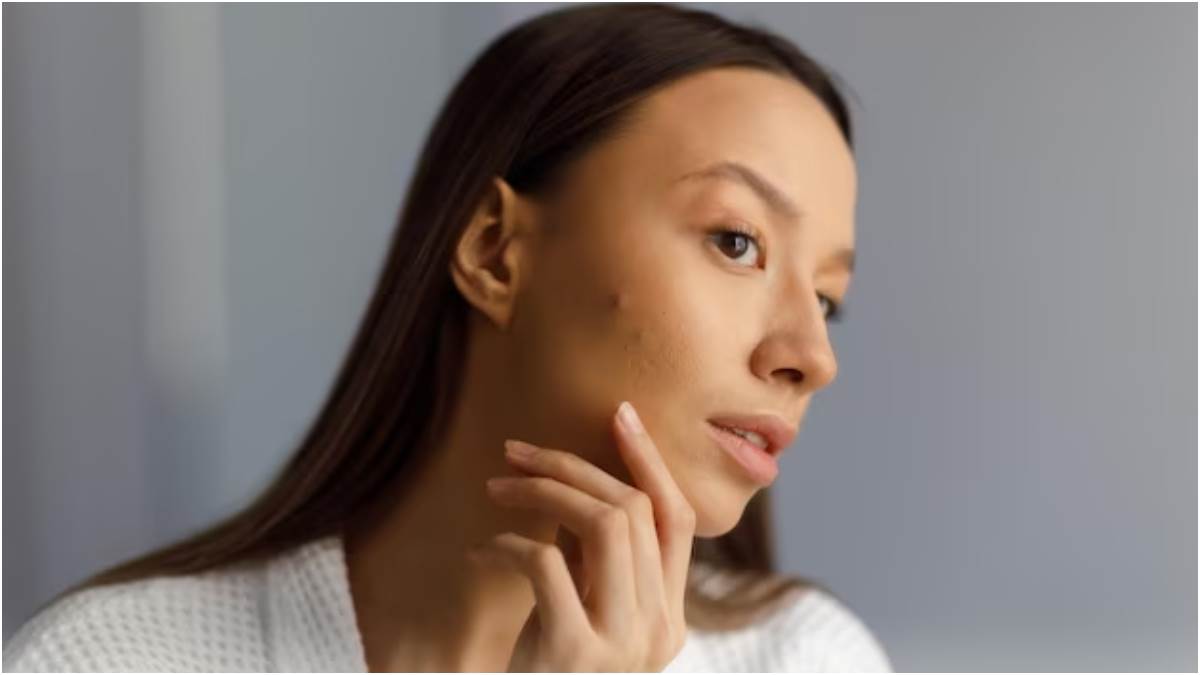 https://www.jagranimages.com/images/newimg/04042023/04_04_2023-acne-mistakes_23375763.jpg