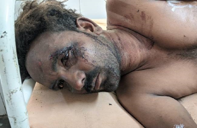 आग में झुलसे एक मरीज की इलाज के दौरान मौत
