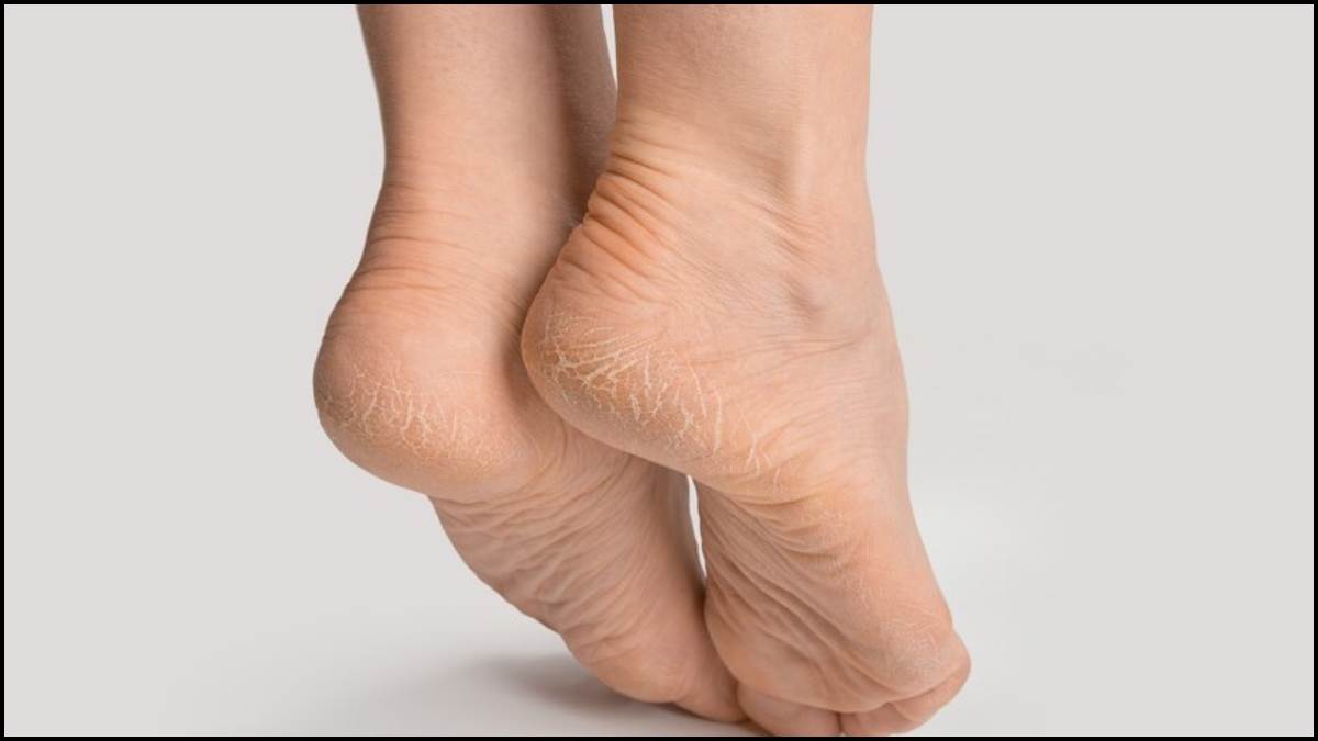 Effective Treatment for Cracked Heels | Goodbye to Foot Pain